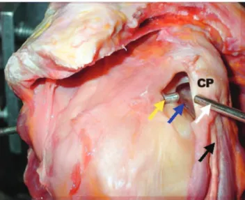 Figure 5 - Right shoulder: CP (coracoid process); transarticular access for the optics through the posterior portal (yellow arrow); subcoracoid space (blue arrow), anterior portal for shaver access (white arrow);