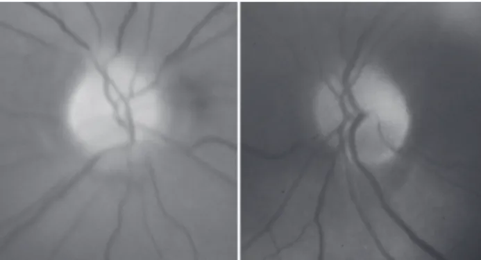 Figure 1 - Fundus photograph 40 days after visual loss showing small (“crowded”) optic discs with pallor most prominent superiorly in both eyes.