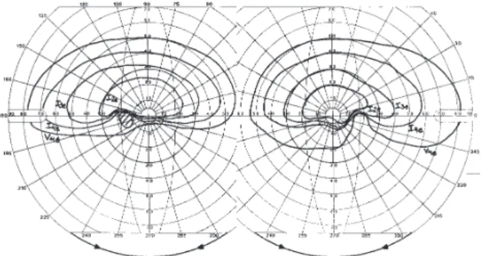 Figure 2 - Goldmann visual field showing severe inferior visual field defect in both eyes.