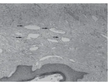 Figure 1 – Microscopic examination of scrotal lesion (1400X magnification).