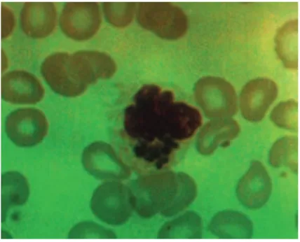 Figure 1 - CHS: blood smear with giant cytoplasmatic granules inside the neutrophils (case 1).