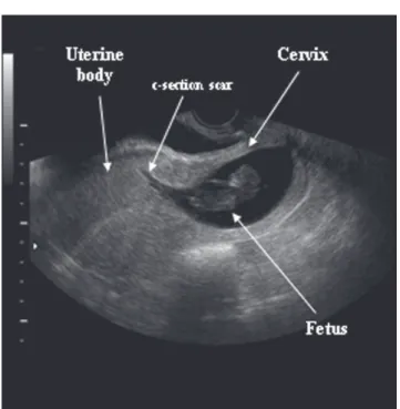 Figure 1. Transvaginal two-dimensional ultrasonography showing a fetus without heart activity, measuring 38.0mm of crown-rump length, located in the cervical portion of the uterus (abortion or cervical pregnancy?)