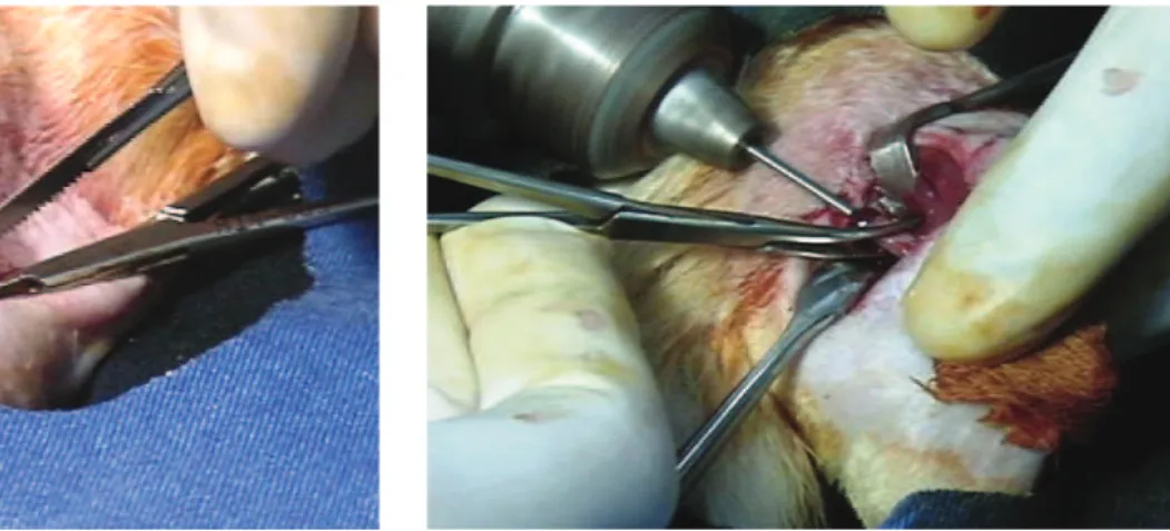 Figure 2 - End of the femur osteotomy with manual sawFigure 1 - Femur osteotomy with manual saw