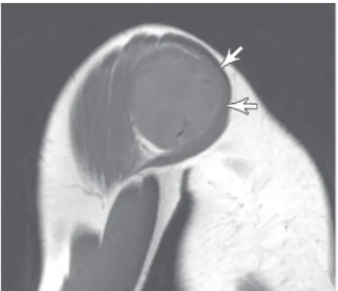 Figure 1a – Sagittal T1-weighted MR image of the shoulder shows a well- well-defined mildly heterogeneous soft tissue mass of intermediate signal intensity displacing the deltoid muscle (arrows)