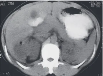 Figure 1 - Computed tomography image of the abdomen showing a gas- gas-containing fluid collection in the inferior portion of the right hepatic lobe, suggesting an infected collection