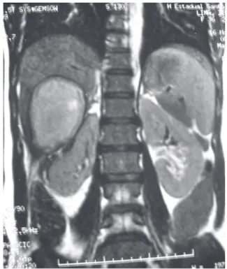 Figure 2 - Magnetic nuclear resonance image disclosing a 7.0-cm homogeneous mass in the segments V and VI of the liver, with peripheral enhancement of the wall after paramagnetic contrast injection, suggesting a hepatic abscess displacing the right kidney 