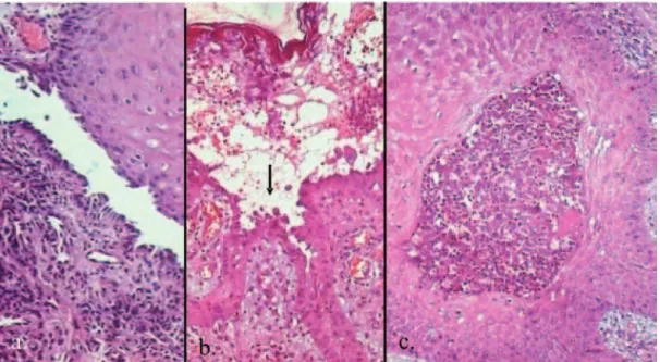 Figure 4 - Light microscopy a. suprabasal cleft in the oral mucosa. b. suprabasal cleft and acantholytic cells (arrow) from a vegetant lesion