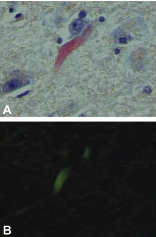 Figure 1 - Histological section from the hippocampus of an autopsied patient.