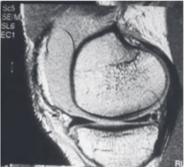Figure 2 - Arthroscopy of knee showing a “pail-handle” meniscal injury