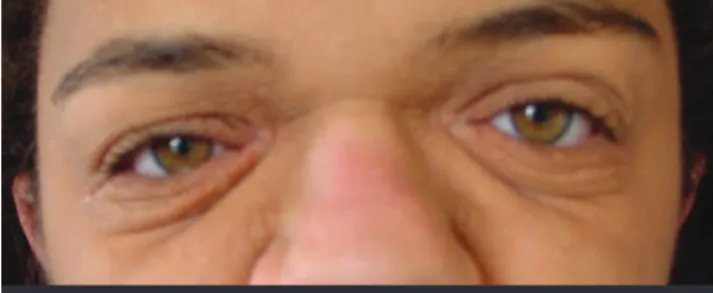 Figure 2 - The hyperplasia of the corneal extract can be seen in greater detail along with an increased number of keratinocytes, an increase of the papillary dermis, and an extension of the dermal papillae