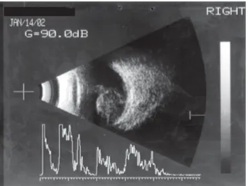 Figure 2 - Case 3 biomicroscopy: a pigmented nodule was detected in the inferior temporal sector of the iris