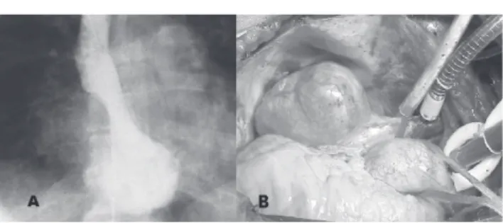 Figure 1 - A. Angiography showing right atrial mass. B. Surgical appearance of the tumor.