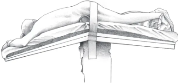 Figure 3 - Planes incised and repaired, exposing the rectal wall, and identification of the fistula.