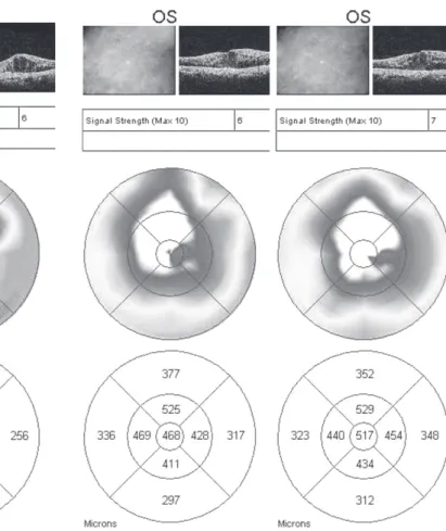 Figure 1 - Fast macular scans of a patient with diffuse diabetic macular edema obtained consecutively