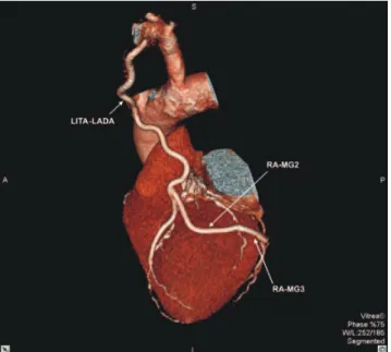 Figure 1 - Three dimensional computed tomography image for Left Internal Thoracic Artery to Left Anterior Descending Artery (LITA – LADA) and Radial Artery to marginal branches 2 and 3 (RA – MG2; RA – MG3).