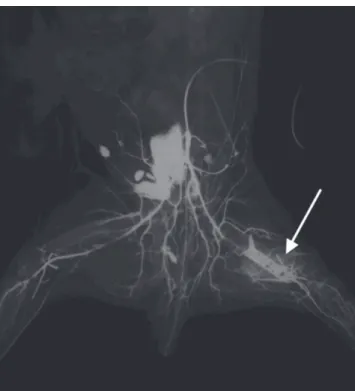 Figure 3 - Arteriographic images of the vascular system of lower abdomen and lower extremities obtained during forced hyperabduction illustrates the location of the osteotomy as well as the longitudinal orientation of the metallic plate and screws in the p