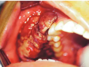 Figure 4 - HIV associated Kaposi´s sarcoma