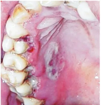 Figure 7 - Oral ulceration, bone exposure and tooth mobility/loss in cancrum oris