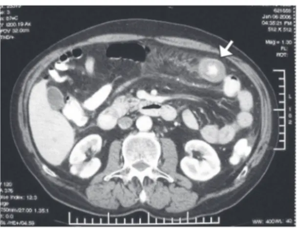 Figure 2 – Contrast CT with transverse slice showing circumferential thickening of the jejunum, known as the “pseudo-kidney” sign (arrow).