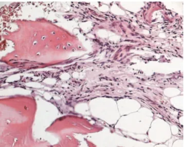 Figure 7 - Histological appearance of the material collected from the percutaneous biopsy, processed in paraffin for staining with hematoxylin and eosin