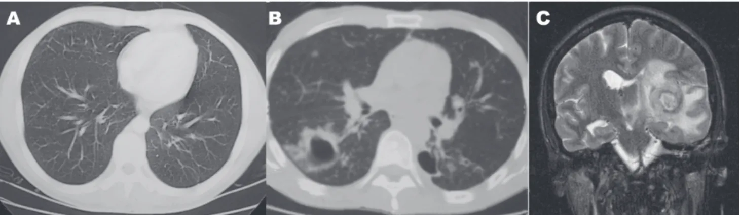 Figure 1 - Thorax CT-scan showing a lung abscess in a patient with Rhodococcus equi bacteremia (B)