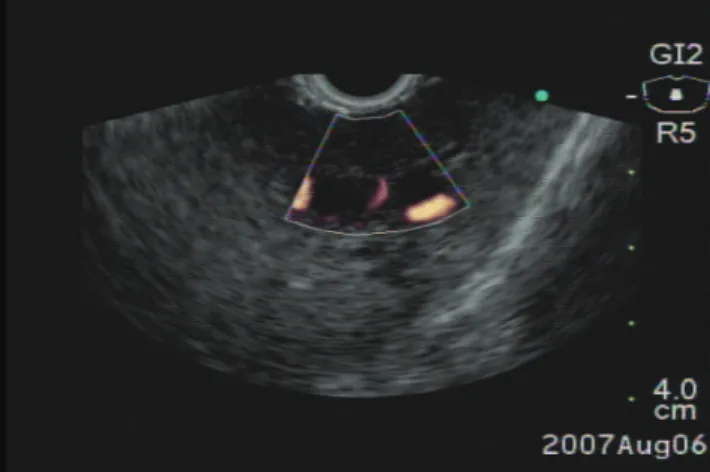 Figure 2 – EUS image demonstrating a 19 – gauge needle puncturing the left hepatic biliary branch undcer endosonography, intrahepatic approach.