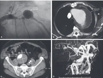 Figure 1 - A - Coronary angiography of left anterior descending coronary artery aneurysm