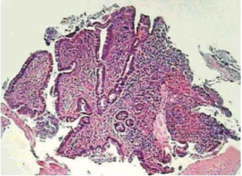 Figure 3 – Optical microscopy demonstrates massive infiltration by small malignant cells in the jejunal mucosa (HE, 40X, biopsy).