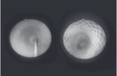 Figure 1 - Broncoscopic aspect of anastomotic stenosis (left) and after Polyflex ®  sten placement (right