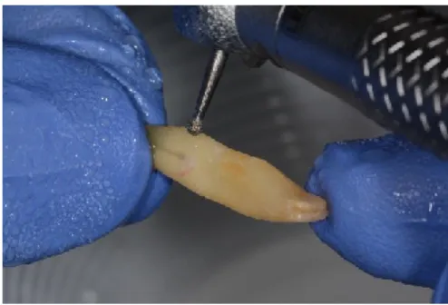 Figura 1 – Remoção dos tecidos periodontais com recurso a broca de carbide de tungsténio