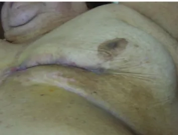 Figure 1 - Left inferior breast necrosis, confirmed by peripheral core needle biopsy, on the ninth postoperative day.