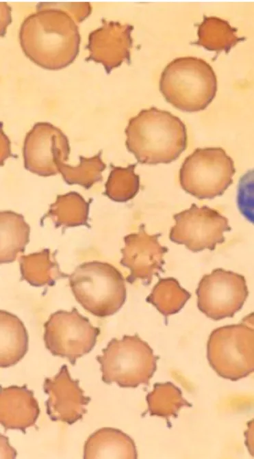 Figure 1 – The spiked red blood cells (acanthocytes) on the peripheral blood.