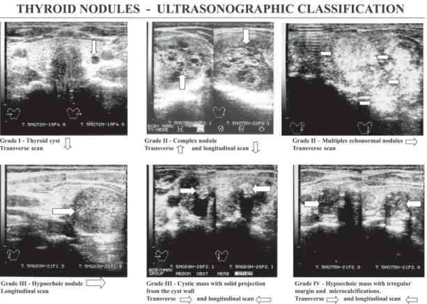 Figure 1 - Ultrasonographic classification of nodules. From top left, clockwise: grade I, a small round anechoic image (thyroid cyst); grade II, a complex nodule (like a sponge); grade II, multiple echonormal nodules; grade III, a hypoechoic solid nodule w