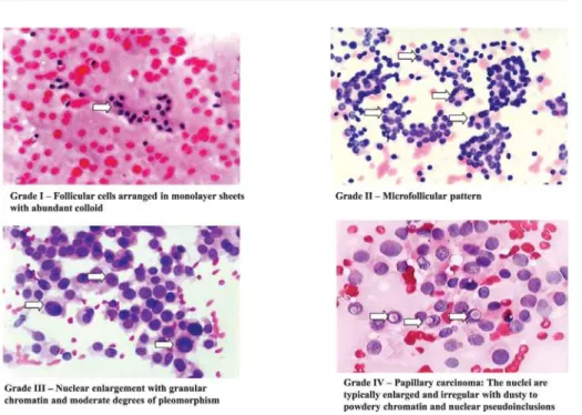 Figure 2 - Cytological classification of aspirates of thyroid nodules. From top left, clockwise: grade I, follicular cells with dense and homogeneous chromatin and abundant colloid; grade II, microfollicular pattern with nuclei with homogenous chromatin an