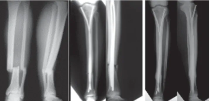 Figure 1 - Appropriate technique for using Ender pins. Proper positioning of the pins provides sufficient stability for union and prevents proximal migration.