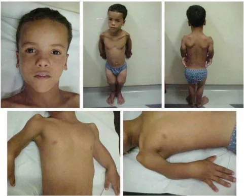 Fig. 1 – 9 year 3 month-old boy with short limbs, typical facies and limited extension of the elbows and knees.