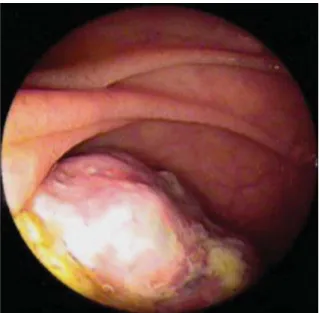 Figure 1. Vegetative lesion on the fourth portion of the duodenum