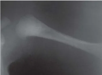 Figure 4 - Radiograph of the left humerus 47 days after the withdrawal of PgE1, showing complete regression of the cortical thickening.