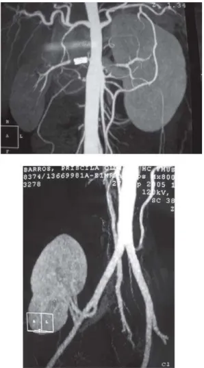 Figure 1A - Computed tomography right renal artery stent occluded and renal perfusion through collateral vessels