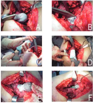Figure 1 - Making of a spacer; A – Proximal confection of the spacer, with bone cement (40,0g) mixed with vancomycin (1,0g) and methylen blue covering the metal of a Müller prosthesis; B – Molding of the bone cement in the bone acetabulum, until total dryi