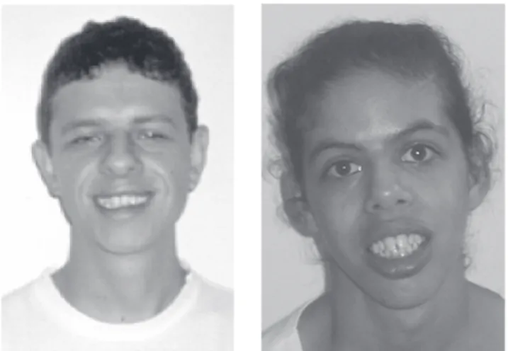 Figure 4a - Two patients (cases 1 and 2) with typical craniofacial features of WS at 9 years of age.