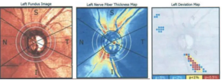Figure 4 - GDx VCC deviation map with a correspondent localized inferior defect in the nerve fiber layer