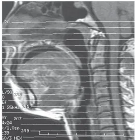 Figure 1 - Axial images programming. The most superior image was programmed cranial to the hard palate, and the most inferior axial image was programmed at the glottic level