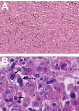 Figure 2 - (A) large macrophage cells with eosinophilic cytoplasm (histiocytes). (B) within the histiocytes as well as extracellularly in the stroma, rounded, concentrically layered, target or ring-like structures that were interpreted as Michaelis-Guttman