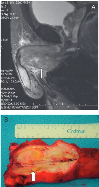 Figure 1A - MRI. The arrow shows deep infiltration into the corpora caver- caver-nosa