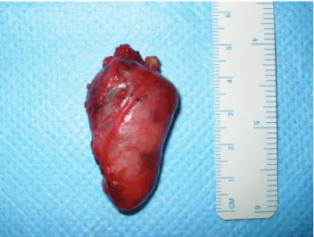 Figure 1 - Neck CT scan showing a well-defined and highly contrast en- en-hanced tumor between the right common carotid artery (CCA) and the right  thyroid lobe (RTL)