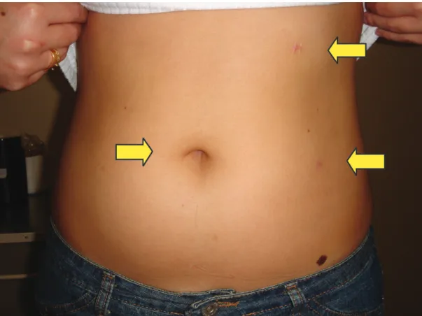 Figure 1 - Port sites demonstrated as surgical scars after left side laparoscopic pyeloplasty