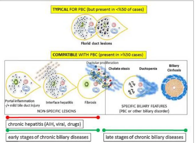 Figura 3- Lesões histológicas típicas e compatíveis da CBP(4)   PBC: Primary Biliary Cholangitis, AIH: Autoimmune Hepatitis 