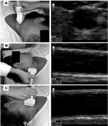 Figure 1 - Observation angles for intima-media thickness measurement: A,  transversal; B, posterolateral; C, anterolateral