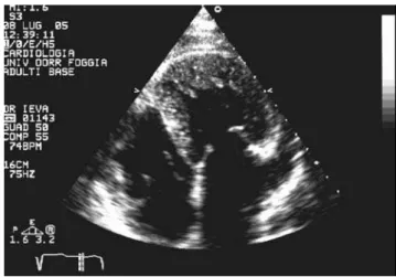 Figure 2 - Apical four-chamber view shows dilatation of both the left atrium  and left appendage and a smooth interventricular septalright surface against  the trabeculated septal left surface in the correct position (normal atrial situs)